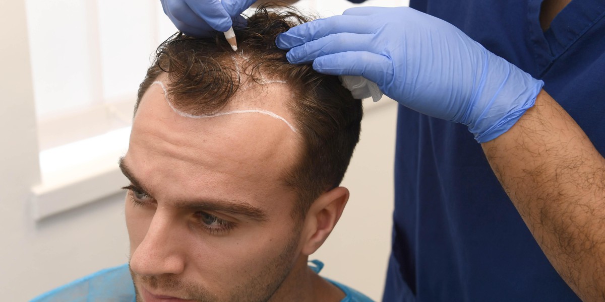 Celebrity Hair Transplant