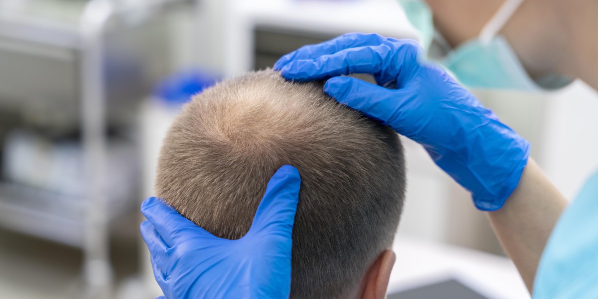 The Benefits Of Hair Replacement Clinics For Hair Loss.