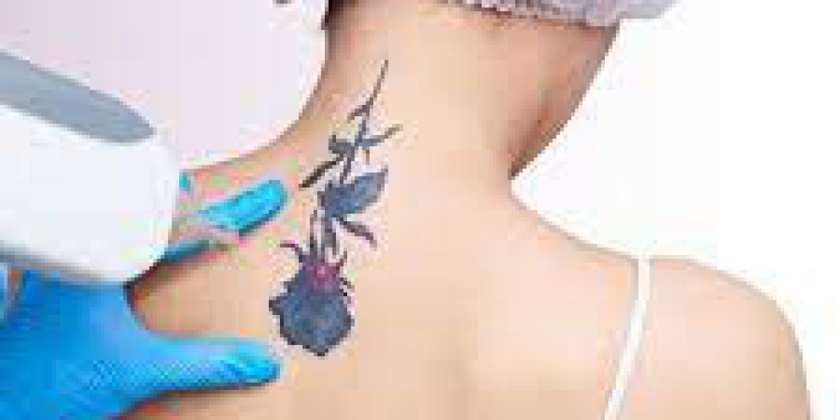 Unlock the Secret to Flawless Skin: Laser Tattoo Removal in Dubai