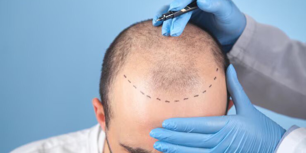 Ultimate Guide to Hair Transplant Strip FUT Surgery