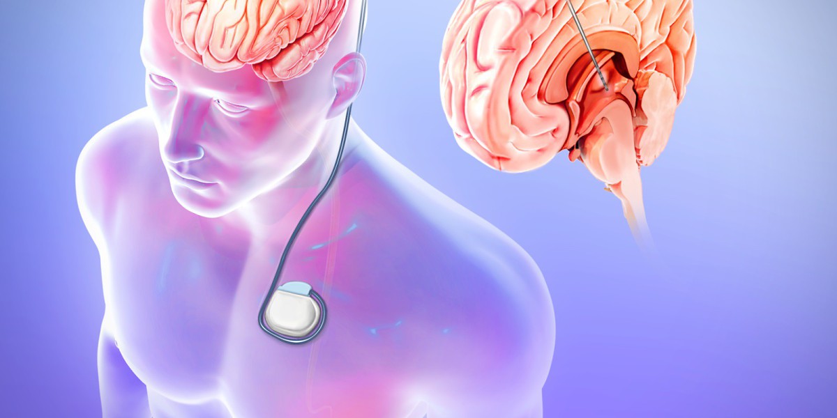 Why Epilepsy Surgery Market Trends Expanding Moderately? Answers Our Report