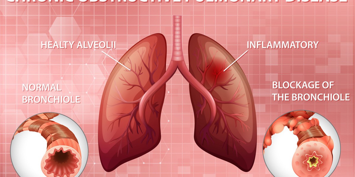 Rising Commonness of Constant Illnesses Anticipated to Push the Global Chronic Obstructive Pulmonary Disease Market Tren