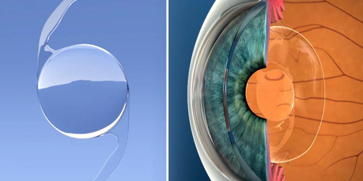 Intraocular Lens Market Trends, Dynamics, Insights, Share, Growth, Key Players & Size
