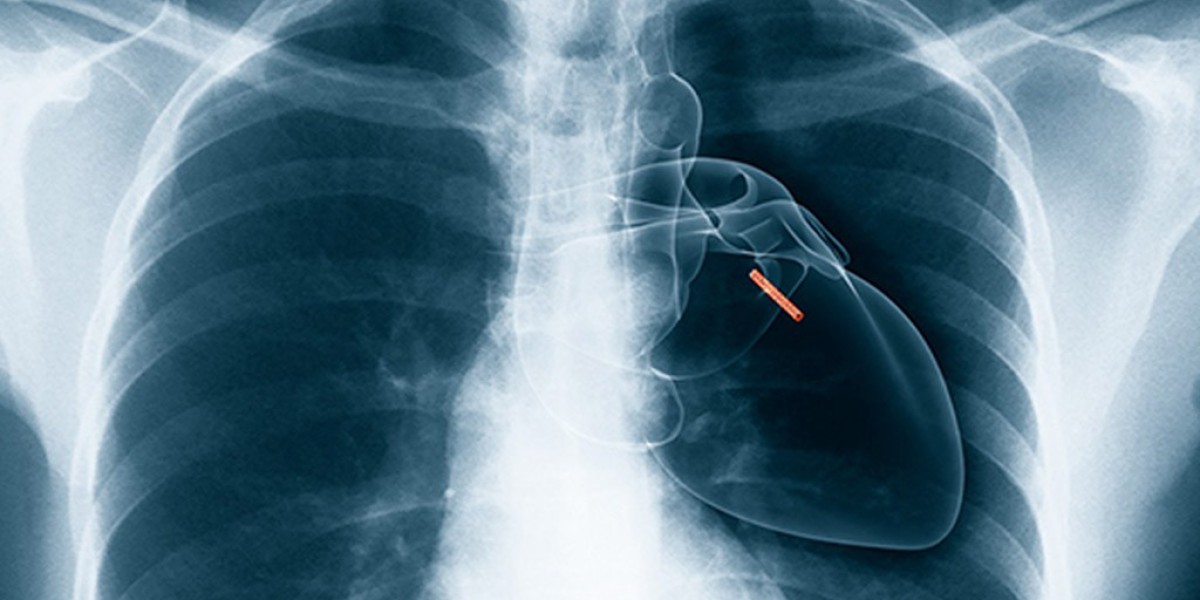 Unlocking the Future: The Lung Stent Market 2024-2032