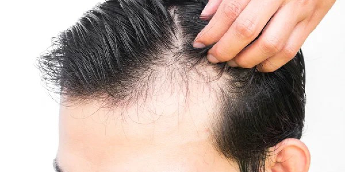 Common misconceptions about hair transplants
