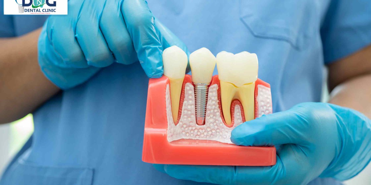 Immediate Dental Implant In Jaipur: A Lifeline For Your Smile