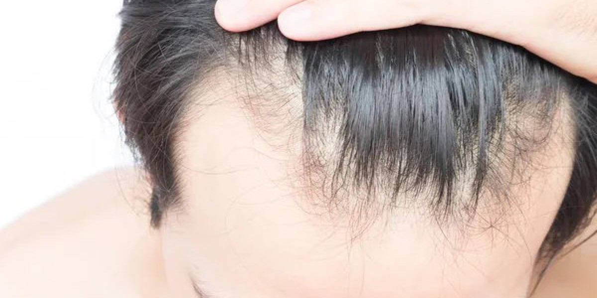 The top 10 reasons to get a hair transplant in Dubai