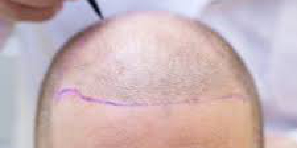 Hair Transplant Dubai: Expectations versus Reality